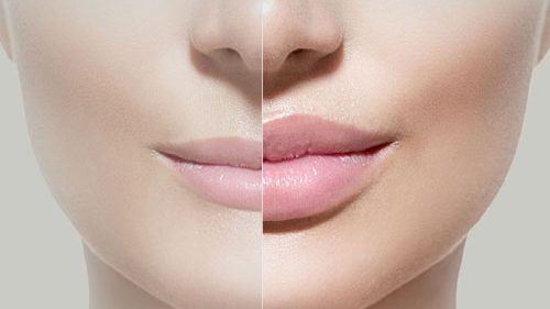 derma-filler-lips