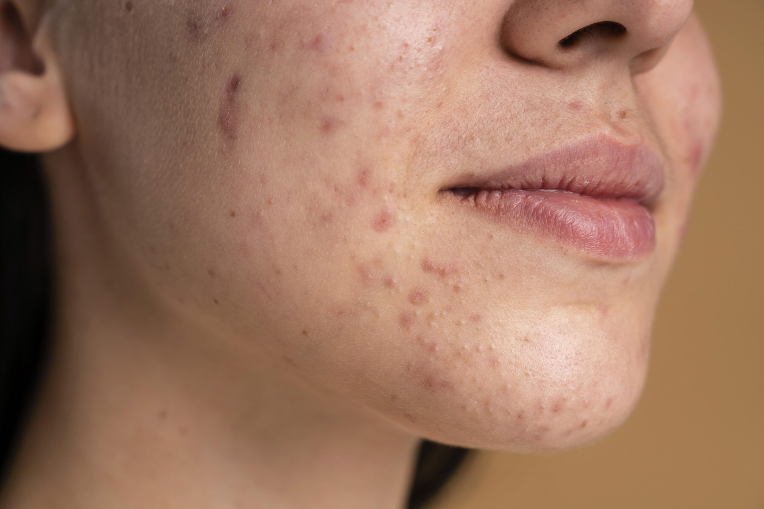 Acne Solutions for Teenagers and Adults in Malta