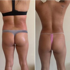 Bodyshock-before-after-results-Malta-soGuapa