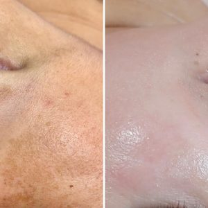 melasma treatment