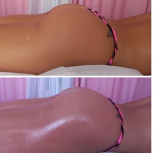 body slimming-treatment